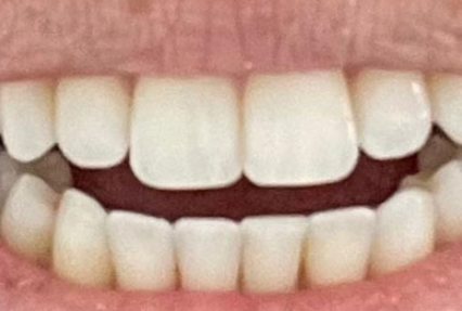 After Invisalign Teeth Alignment Case 2